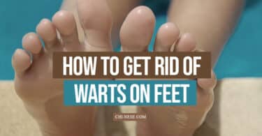 How to get rid of warts on feet
