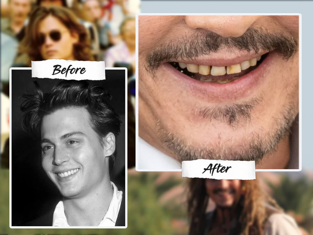 johnny depp teeth before and after