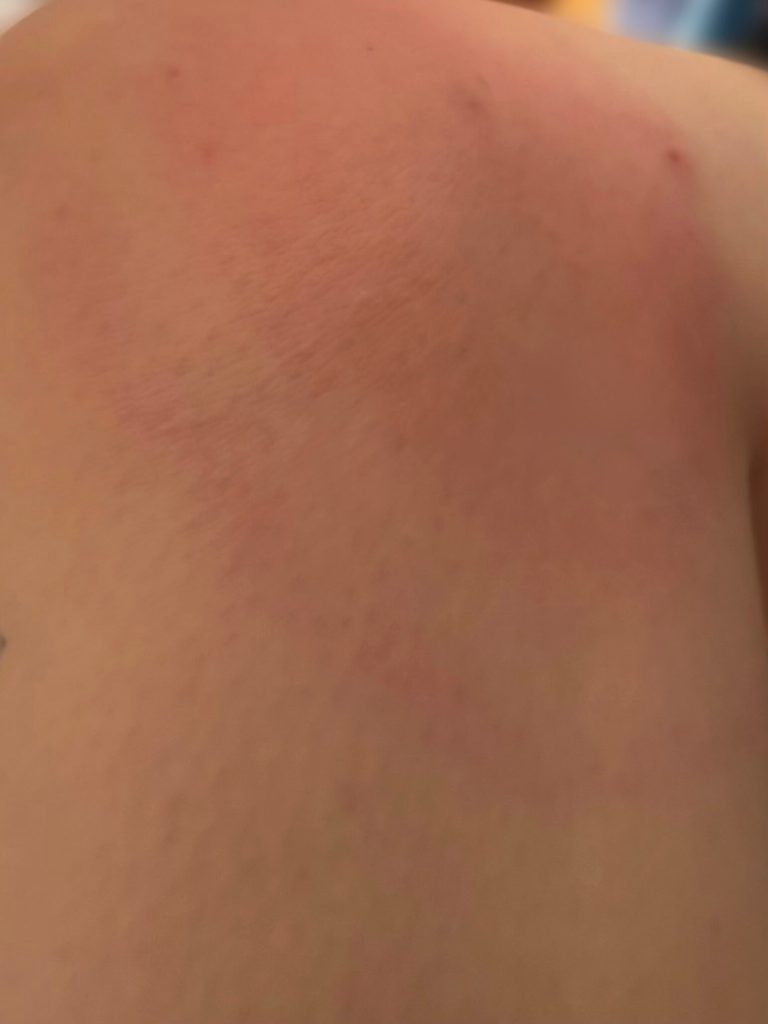 lyme disease rash