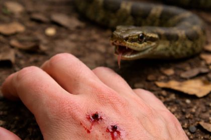 snake bite on hand